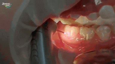 Implantologie Carii cu laserul Obturatii stimatologie brasov medic stomatologic brasov