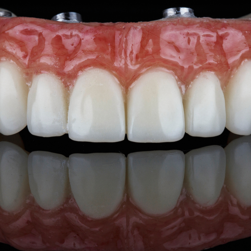 Implanturi dentare Brașov Proteze pe implanturi dentare Brașov Cost implant dentar Brașov Clinică implanturi dentare Brașov Specialist implanturi dentare Brașov Implant dentar all-on-4 Brașov Proteze dentare pe implanturi Brașov Preț proteze pe implanturi dentare Implant dentar fără durere Brașov Îngrijire după implant dentar Brașov Cea mai bună clinică de implanturi dentare Brașov Reabilitare orală cu implanturi dentare Brașov Implantologie avansată Brașov Avantaje proteze pe implanturi dentare Implanturi dentare rapide Brașov Cât costă un implant dentar în Brașov Implanturi dentare de calitate Brașov Tratamente moderne implant dentar Brașov Recuperare după proteze pe implanturi Brașov Estetica dentară cu implanturi în Brașov Implanturi dentare Brașov Proteze pe implanturi dentare Brașov Cost implant dentar Brașov Clinică implanturi dentare Brașov Specialist implanturi dentare Brașov Implant dentar all-on-4 Brașov Proteze dentare pe implanturi Brașov Preț proteze pe implanturi dentare Implant dentar fără durere Brașov Îngrijire după implant dentar Brașov Cea mai bună clinică de implanturi dentare Brașov Reabilitare orală cu implanturi dentare Brașov Implantologie avansată Brașov Avantaje proteze pe implanturi dentare Implanturi dentare rapide Brașov Cât costă un implant dentar în Brașov Implanturi dentare de calitate Brașov Tratamente moderne implant dentar Brașov Recuperare după proteze pe implanturi Brașov Estetica dentară cu implanturi în Brașov