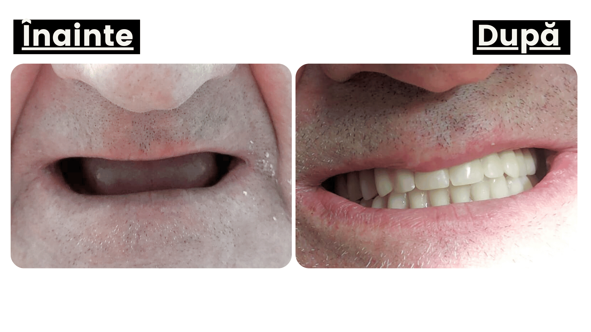 Proteză mobilă sau proteză fixă Proteză mobilă sau proteză fixă